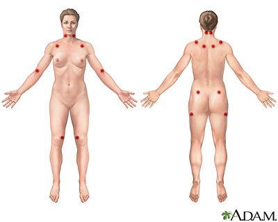 Fibromyalgia Fibromyalgia