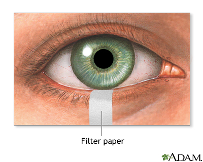 Schirmer's test