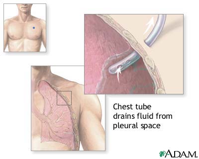 Chest tube insertion Chest tube insertion