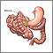 Volvulus Volvulus