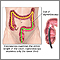 Colonoscopy Colonoscopy