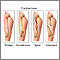 Fracture types (1) Fracture types (1)
