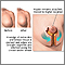 Mammoplasty Mammoplasty