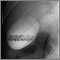 Gallstones, cholangiogram Gallstones, cholangiogram