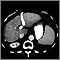 Liver cirrhosis - CT scan Liver cirrhosis - CT scan