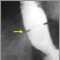 Schatzki ring - x-ray Schatzki ring - x-ray