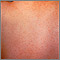 ECHO virus type 9 - exanthem ECHO virus type 9 - exanthem