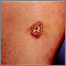 Kaposi sarcoma - lesion on the foot Kaposi sarcoma - lesion on the foot