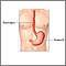Gastrostomy tube placement - series Gastrostomy tube placement - series