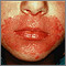 Candidiasis, cutaneous - around the mouth Candidiasis, cutaneous - around the mouth