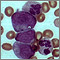 Chronic myelocytic leukemia Chronic myelocytic leukemia