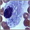 Gaucher cell - photomicrograph #2 Gaucher cell - photomicrograph #2
