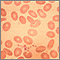 Ovalocytoses Ovalocytoses