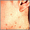 Warts - flat on the cheek and neck Warts - flat on the cheek and neck