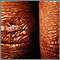 Dermatomyositis - Gottron papule Dermatomyositis - Gottron papule