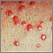 Xanthoma, eruptive - close-up Xanthoma, eruptive - close-up