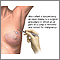 Open biopsy of the breast Open biopsy of the breast