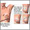 Breast self-exam Breast self-exam