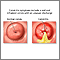 Cervicitis Cervicitis