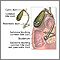 Choledocholithiasis Choledocholithiasis
