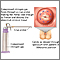 Cervical cryosurgery Cervical cryosurgery