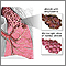 Emphysema Emphysema