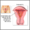 Endometritis Endometritis