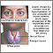 Graves disease Graves disease