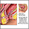 Hemorrhoids Hemorrhoids