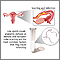 Primary infertility Primary infertility