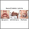 Beckwith-Wiedemann syndrome