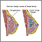 Causes of Breast Lumps