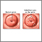 Nabothian cyst Nabothian cyst
