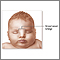 Broad nasal bridge Broad nasal bridge