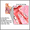 Bronchiolitis Bronchiolitis