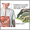 Brucellosis Brucellosis