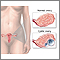 Ovarian cysts Ovarian cysts