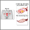 Ovarian hypofunction Ovarian hypofunction
