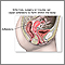 Pelvic adhesions Pelvic adhesions