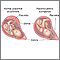 Placenta previa Placenta previa