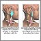 Primary and secondary hypothyroidism