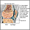 Rheumatoid arthritis Rheumatoid arthritis