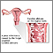 Yeast infections Yeast infections