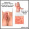Congenital herpes Congenital herpes