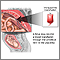 Intrauterine transfusion Intrauterine transfusion