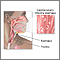 Candidal esophagitis Candidal esophagitis