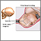 Fetal head molding Fetal head molding