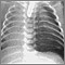 Pneumothorax - chest X-ray Pneumothorax - chest X-ray