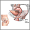 Stress incontinence Stress incontinence