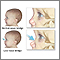 Low nasal bridge Low nasal bridge